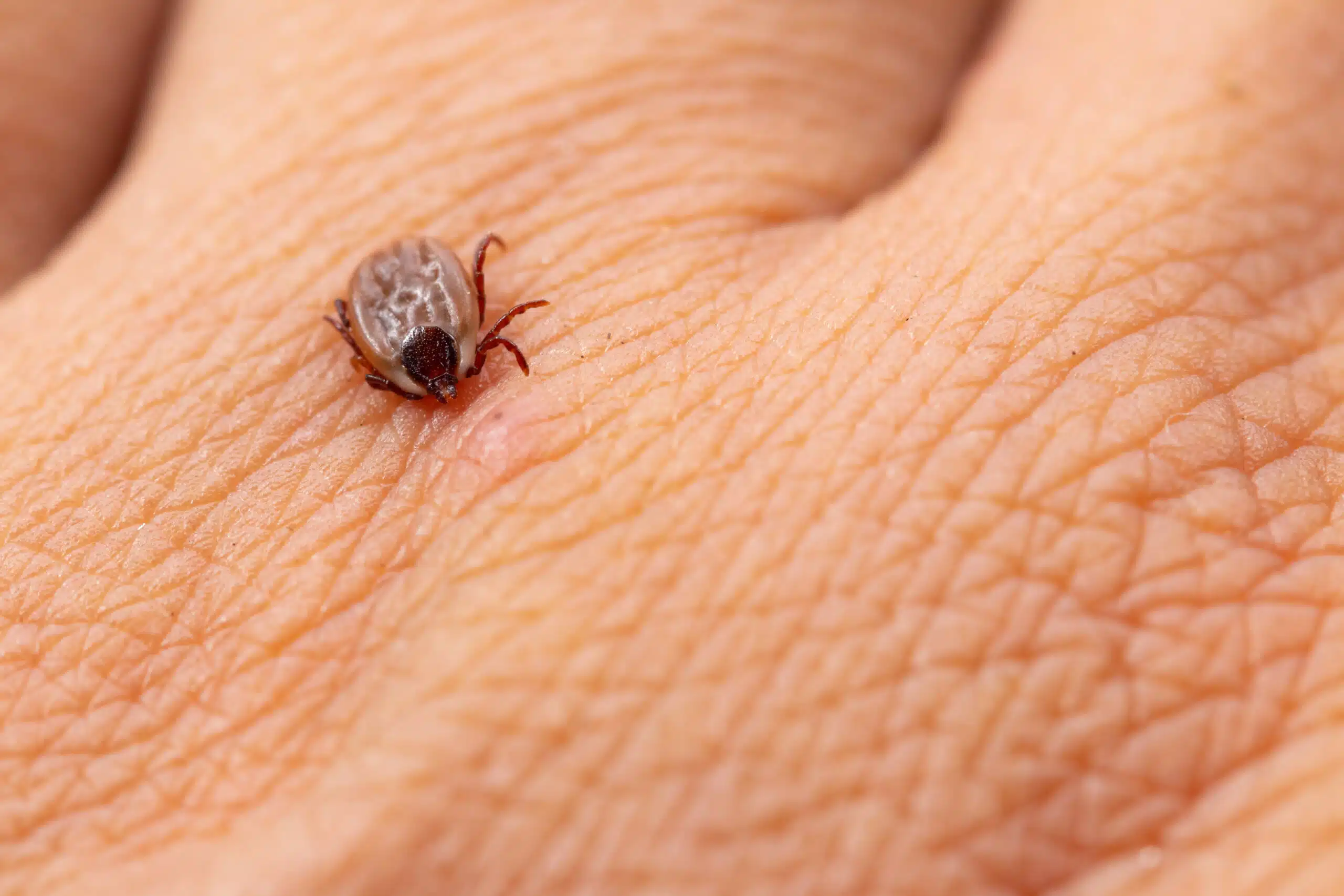 How to Properly Remove a Tick in Massachusetts